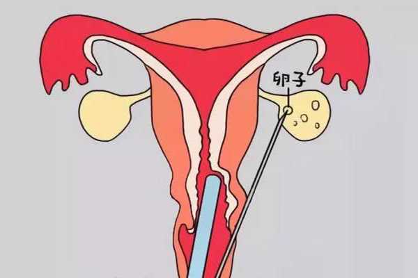 先天无子宫且卵巢正常,好孕难关有2点,腹部取卵能帮其一